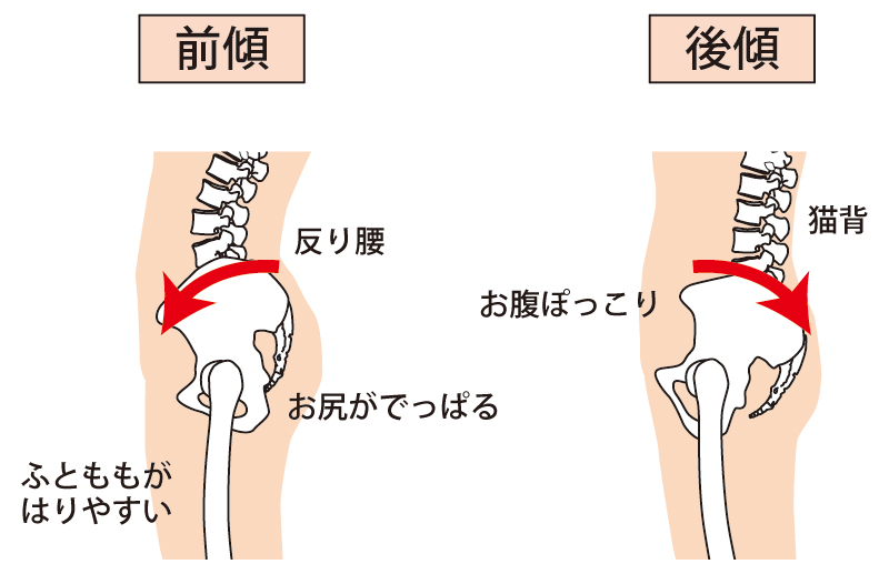 骨盤前傾と骨盤後傾の比較イラスト